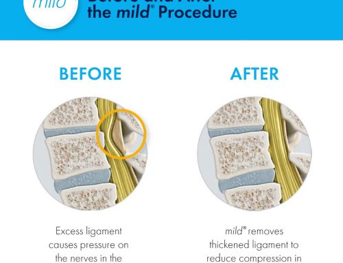 We are now offering the mild® Procedure